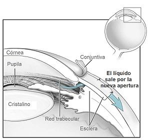 300px-Conventional_surgery_to_treat_glaucoma_EDA11-es.jpg