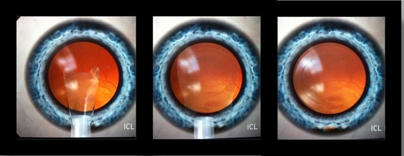ICL Pasos Qx