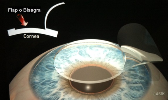 Pasos Lasik 1