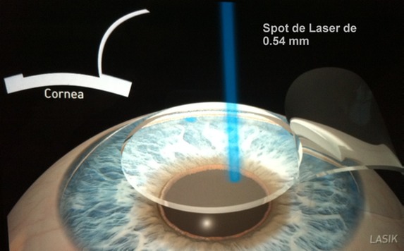 Pasos Lasik 2