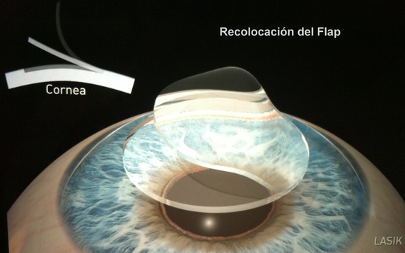 Pasos Lasik 3