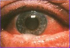 Conjuntivitis