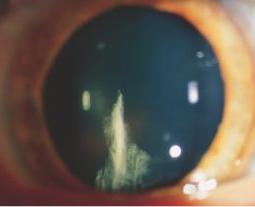 Catarata Cortical
