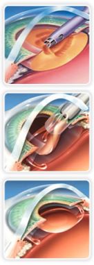Facoemulsificación