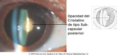 Catarata Subcapsular Posterior