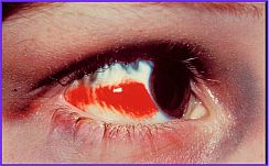 Hemorragia Subconjuntival (derrame)