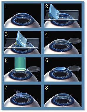 Técnica de LASIK