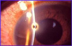 Cuerpo extraño corneal (rebaba)